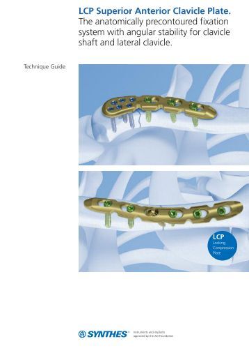 plate osteosynthesis plate osteosynthesis