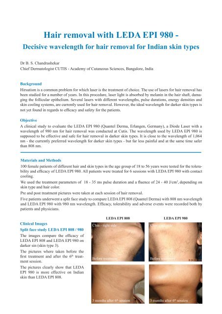 Hair Removal With Leda Epi 980 Quantel Derma