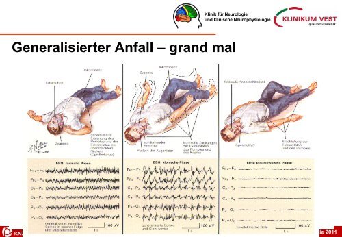 Epilepsie - Verein zur Förderung der Neurologie eV