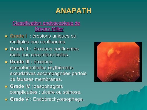 Le Reflux Gastro- Oesophagien Ã  l'heure de la MÃ©decine Factuelle