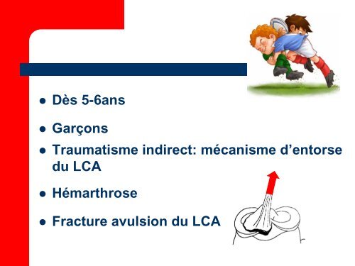 Fracture des Epines Tibiales - SOFOP