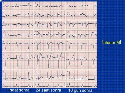 TEMEL EKG