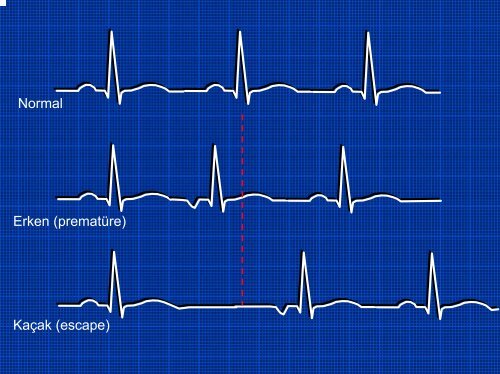 TEMEL EKG