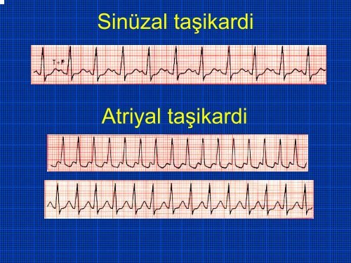 TEMEL EKG