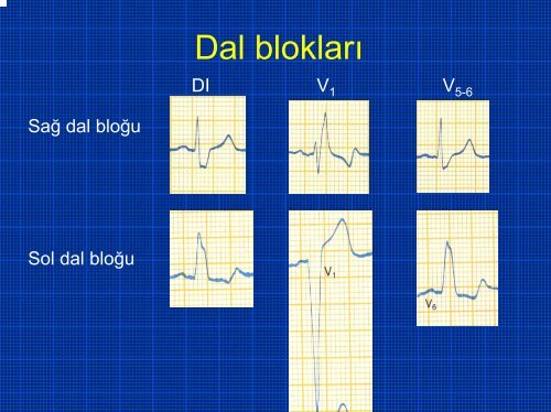 TEMEL EKG