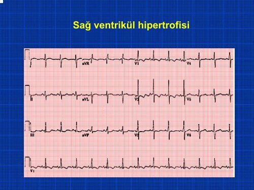 TEMEL EKG