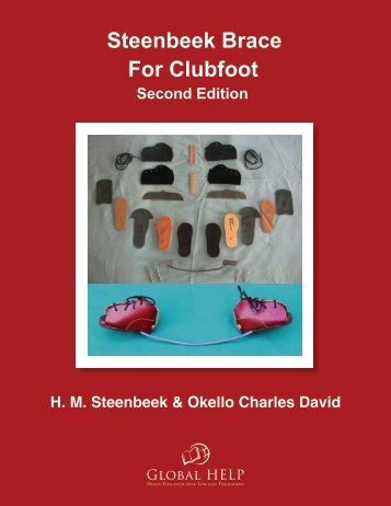 Steenbeek Brace For Clubfoot [2nd Edition] - Global HELP