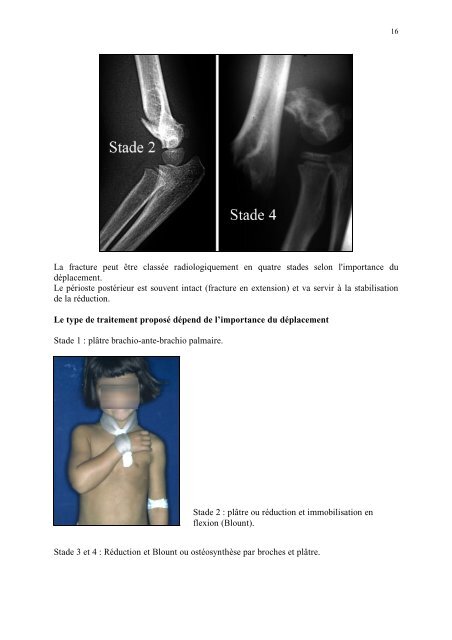 Fractures chez l'enfant : particularitÃ©s Ã©pidÃ©miologiques ...