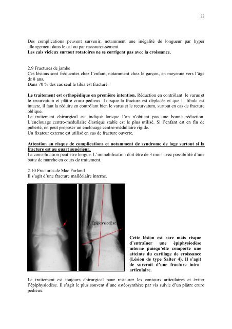 Fractures chez l'enfant : particularitÃ©s Ã©pidÃ©miologiques ...