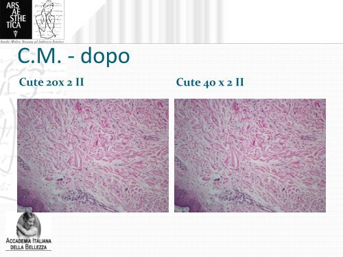 Microvibrazione compressiva