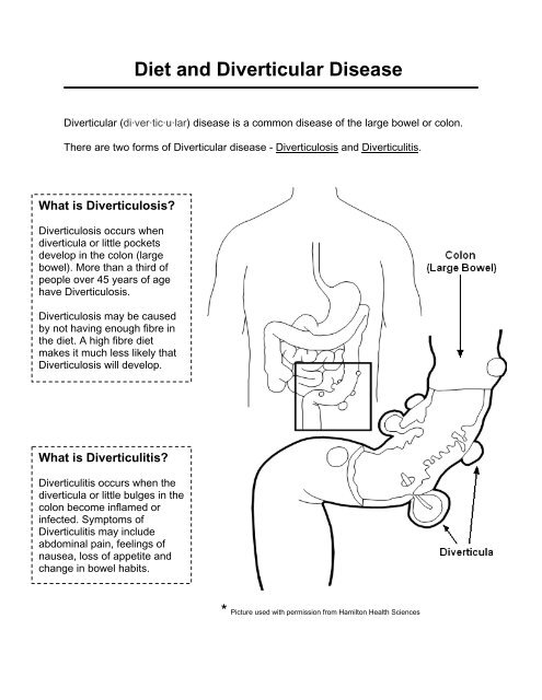 Diet and Diverticular Disease - Hamilton Family Health Team