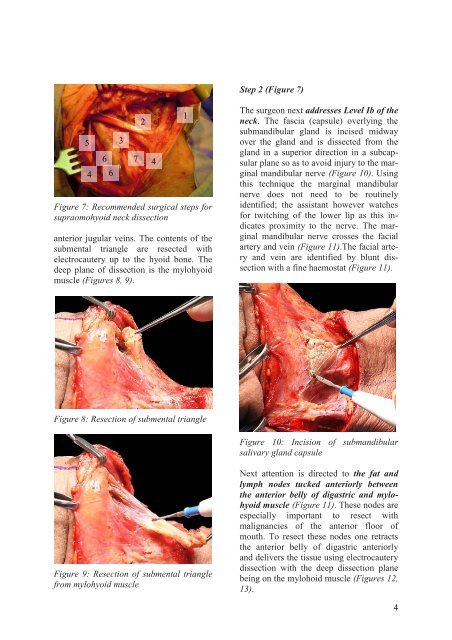 Selective Neck Dissection - Vula - University of Cape Town