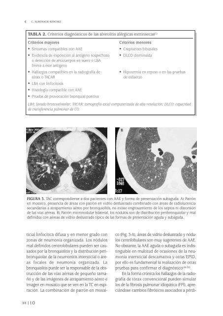 Enfermedades pulmonares intersticiales difusas - Neumomadrid