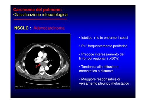 (Microsoft PowerPoint - CANCRO DEL POLMONE 1 LEZIONE 2010 ...