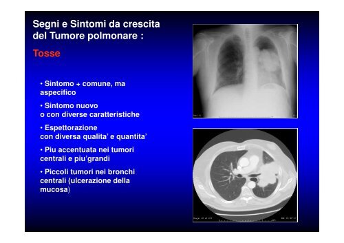 (Microsoft PowerPoint - CANCRO DEL POLMONE 1 LEZIONE 2010 ...