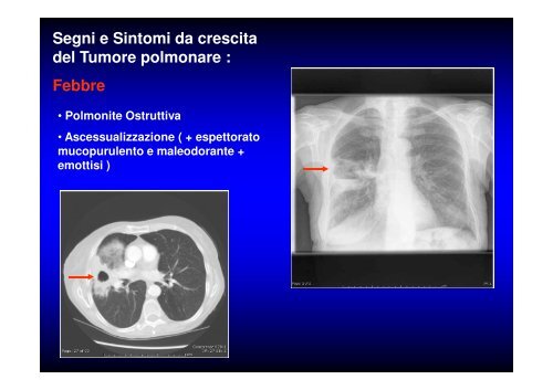 (Microsoft PowerPoint - CANCRO DEL POLMONE 1 LEZIONE 2010 ...