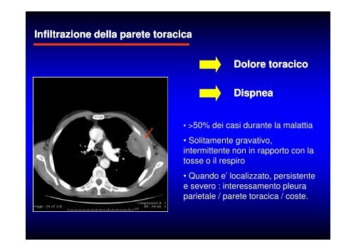 (Microsoft PowerPoint - CANCRO DEL POLMONE 1 LEZIONE 2010 ...