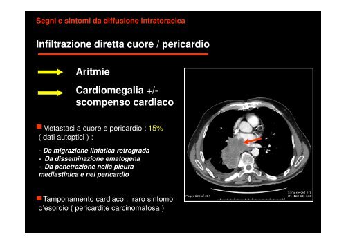 (Microsoft PowerPoint - CANCRO DEL POLMONE 1 LEZIONE 2010 ...