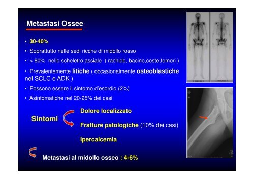 (Microsoft PowerPoint - CANCRO DEL POLMONE 1 LEZIONE 2010 ...