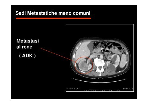 (Microsoft PowerPoint - CANCRO DEL POLMONE 1 LEZIONE 2010 ...