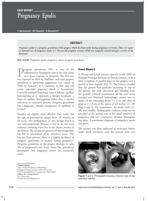 Pregnancy Epulis - IJMD