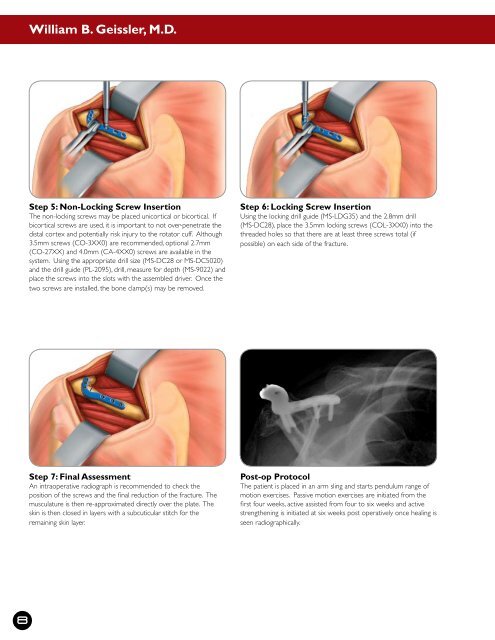 Scapula Plates, Acumed - ShoulderDoc.co.uk