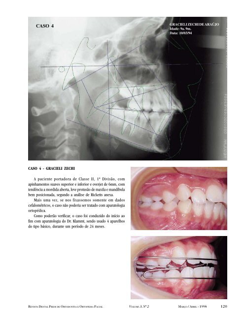 Ativador Aberto ElÃ¡stico de Klammt - Dental Press