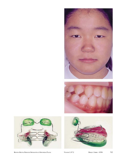 Ativador Aberto ElÃ¡stico de Klammt - Dental Press