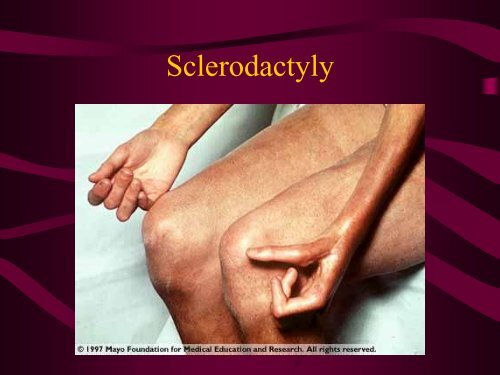 Scleroderma & CREST Syndrome