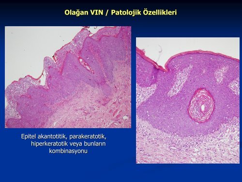 VulvanÄ±n ÃncÃ¼l LezyonlarÄ±