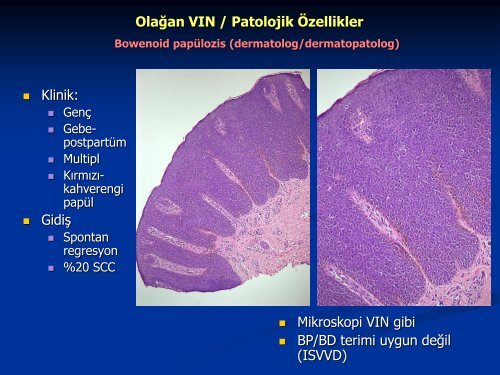 VulvanÄ±n ÃncÃ¼l LezyonlarÄ±