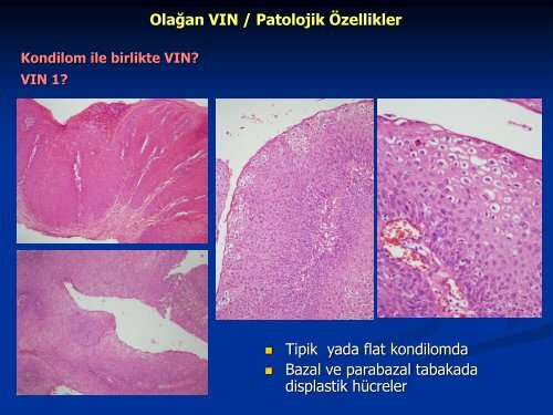 VulvanÄ±n ÃncÃ¼l LezyonlarÄ±