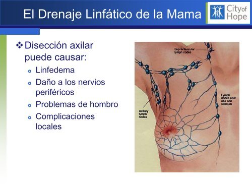 Biopsia del Linfonodo Centinela en CÃ¡ncer de Mama