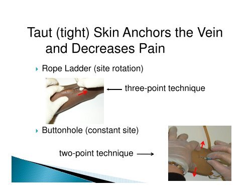 Complications of the Buttonhole Technique