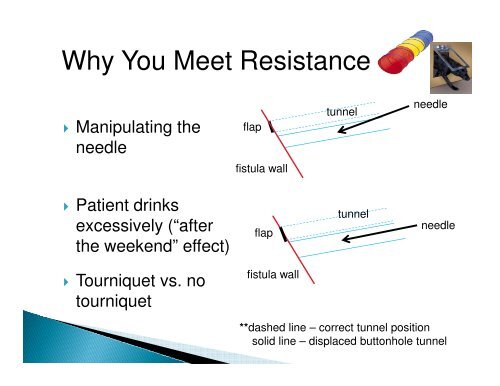 Complications of the Buttonhole Technique