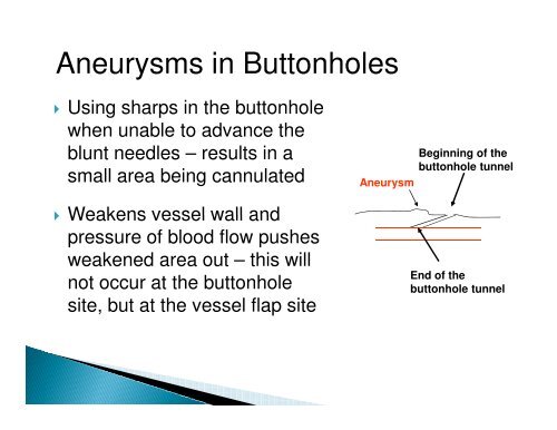 Complications of the Buttonhole Technique