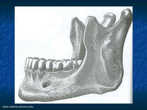 DislocaciÃ³n y Fractura Mandibular - Reeme.arizona.edu