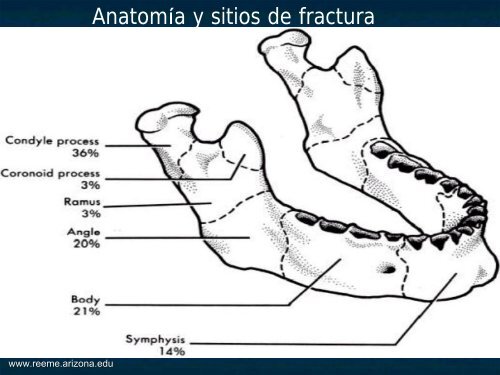 DislocaciÃ³n y Fractura Mandibular - Reeme.arizona.edu