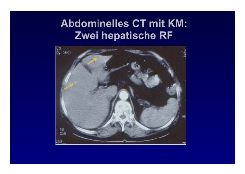 duodenaler GIST - medizin-telegramm