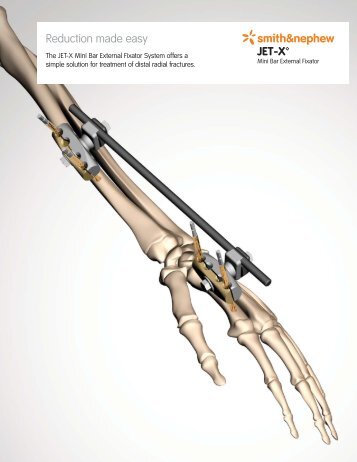 JET-X™ *smith&nephew Reduction made easy - Osteosyntese