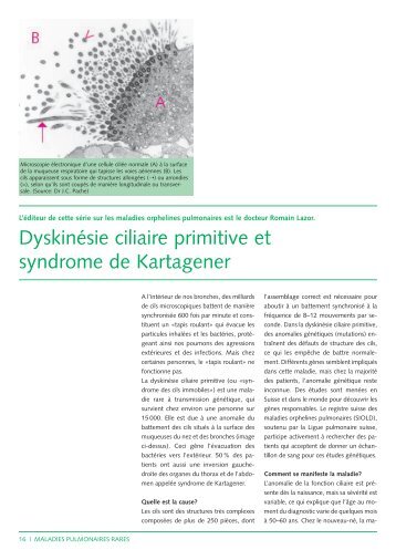 DyskinÃ©sie ciliaire primitive et syndrome de Kartagener - CHUV