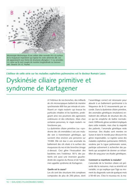 DyskinÃ©sie ciliaire primitive et syndrome de Kartagener - CHUV