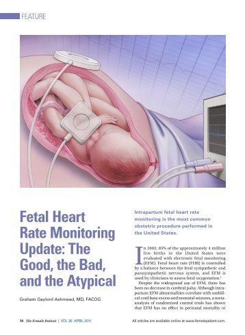 Fetal Heart Rate Monitoring Update - The Female Patient