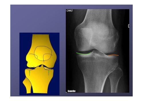 Radiographie du genou - JN Ravey