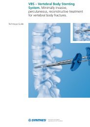 VBS â Vertebral Body Stenting System. Minimally invasive ...