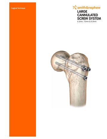 Surgical Technics Cannulated Screws.pdf - Osteosyntese