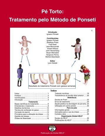 PÃ© torto: tratamento pelo mÃ©todo Ponseti - Global HELP