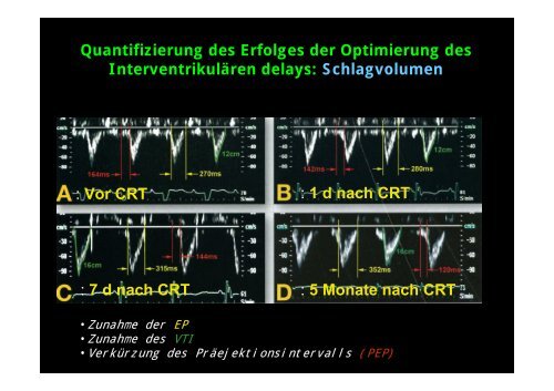 InterventrikulÃ¤res delay - Tschwalm.de