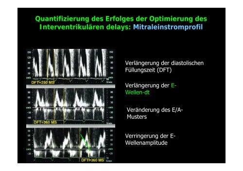 InterventrikulÃ¤res delay - Tschwalm.de