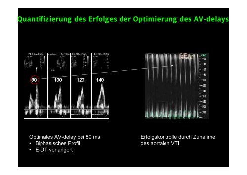 InterventrikulÃ¤res delay - Tschwalm.de